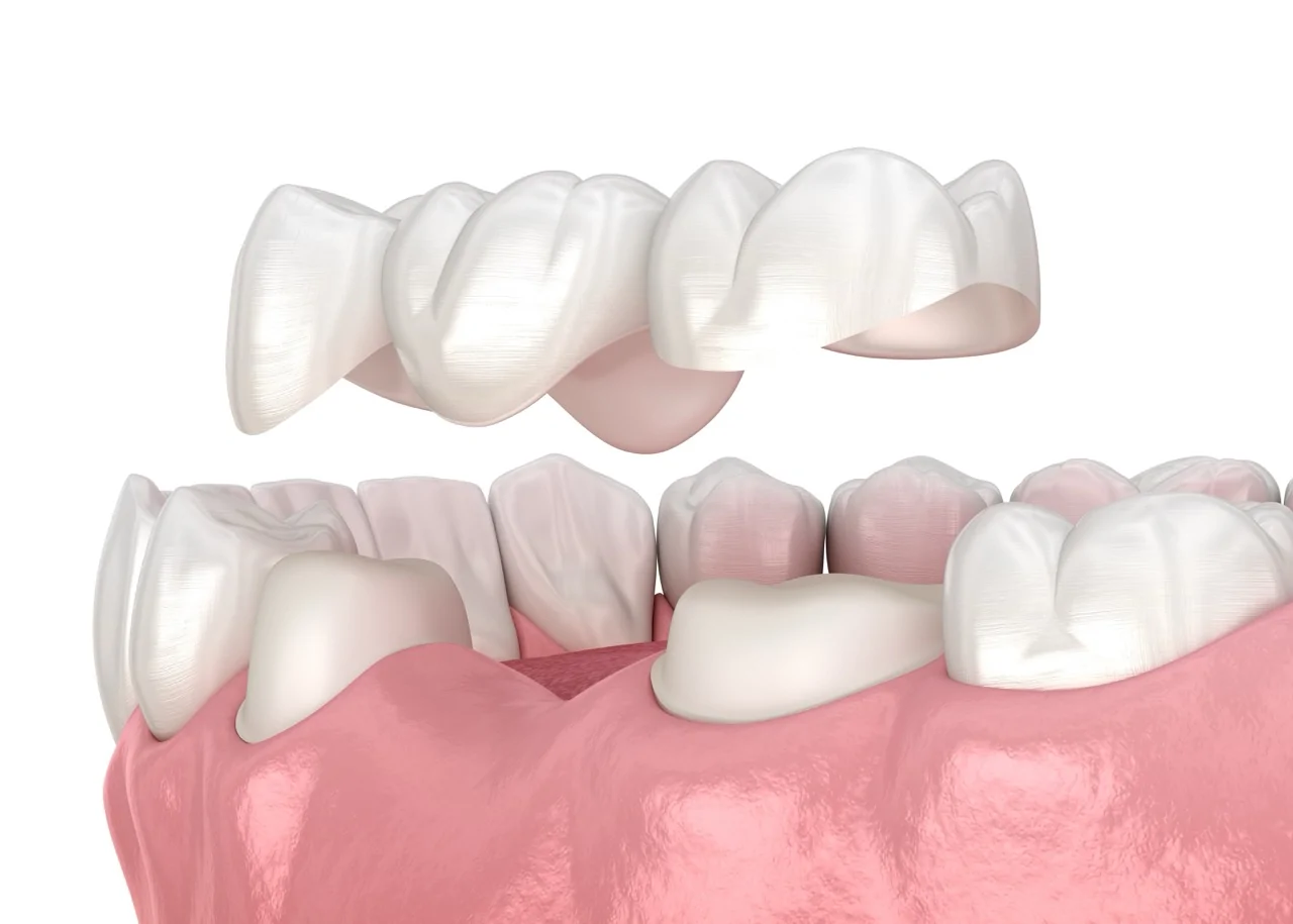 Zirconia Crowns Zirconia Crowns treatment at Designer Smiles dental clinic in Vile Parle East, Mumbai