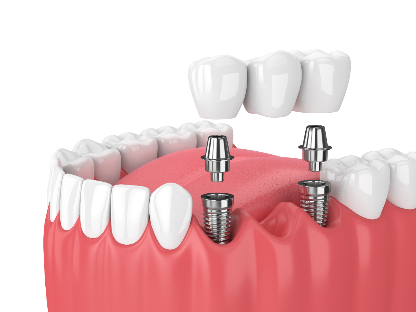Dental Implants Dental Implants treatment at Designer Smiles dental clinic in Vile Parle East, Mumbai