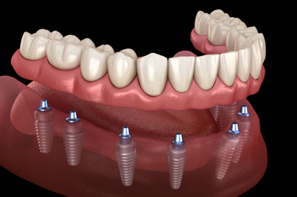 Full Mouth Rehabilitation Full Mouth Rehabilitation treatment at Designer Smiles dental clinic in Vile Parle East, Mumbai